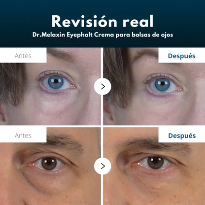 Dr. Melaxin™ Eyephalt Crema para eliminar bolsas ojeras